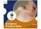 Discover Lipoma Treatment Without Surgery With Lipoma Wand