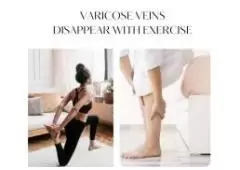  A Comprehensive Guide to Vanishing Varicose Veins with Exercise