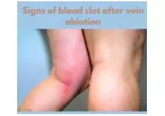 A Comprehensive Guide to Blood Clots After Vein Ablation