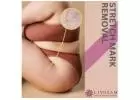 Stretch marks treatment With Livglam in Bangalore