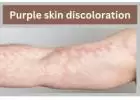  Purple Skin Discoloration: What You Need to Know
